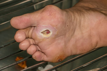 Diabetic Foot Care