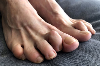 Hammertoes